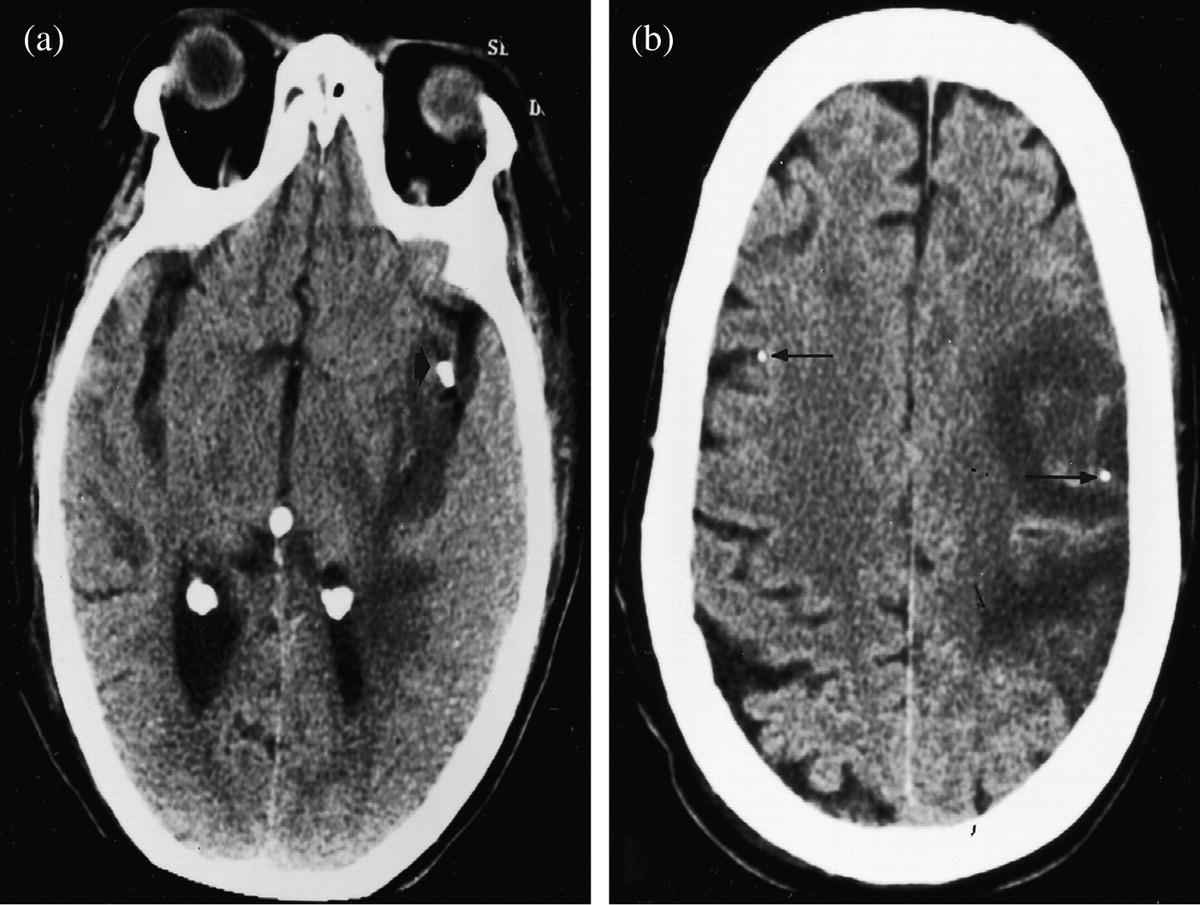 Radio graph of axial view (left) and dorsal view (right) of the brain.