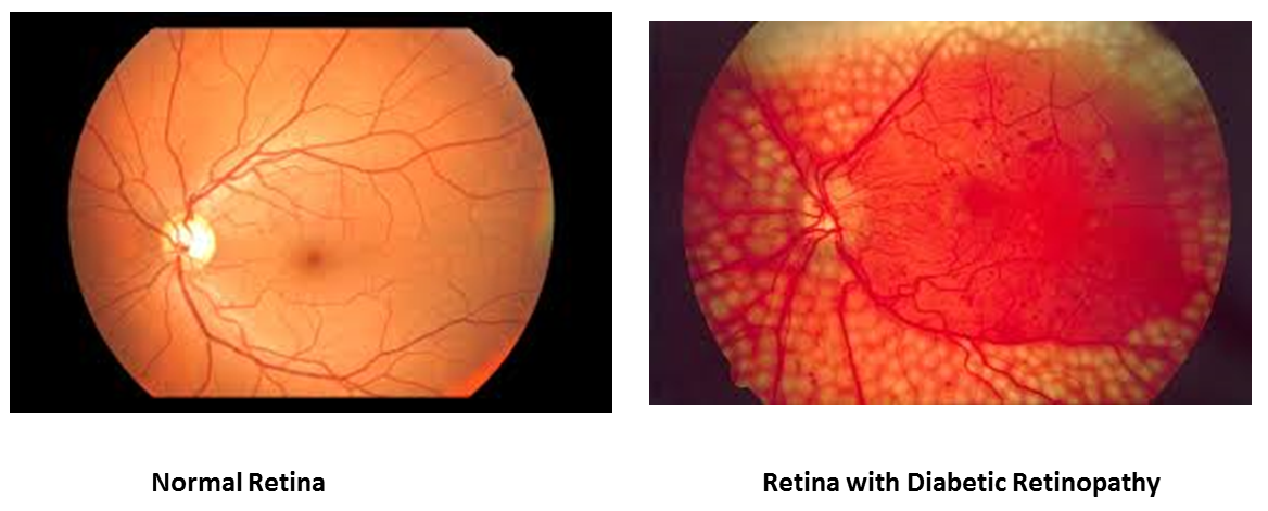 normal retina